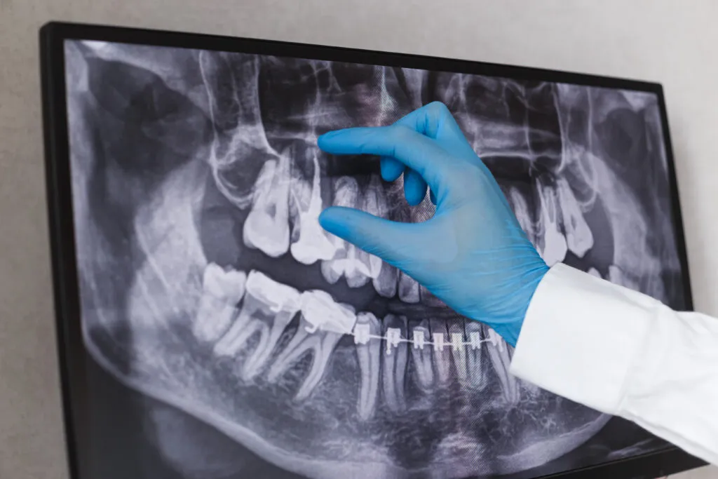 Endodonție